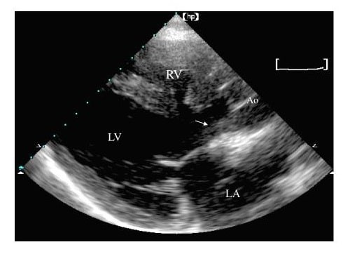 Siêu âm tim để chẩn đoán bệnh Thất phải hai đường ra