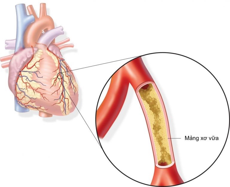 Xơ vữa động mạch làm hẹp lòng động mạch vành dẫn đến thiếu máu cơ tim