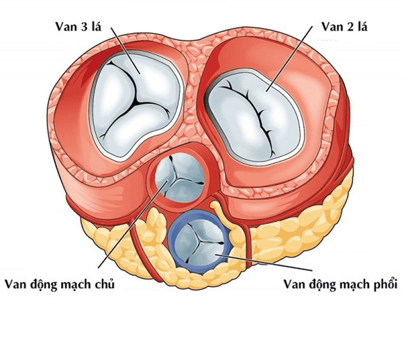 Bệnh tim sa van hai lá là bệnh mãn tính