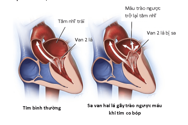 Sa van hai lé gây trào ngược máu khi tim co bóp