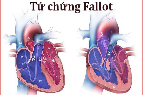 Tim của người bị tứ chứng Fallot