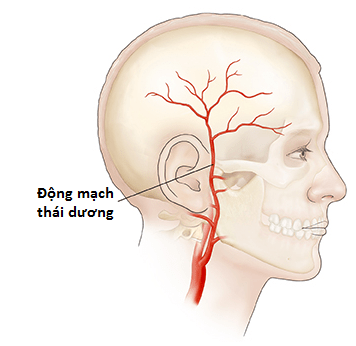 viêm động mạch thái dương