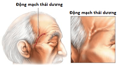 viêm động mạch thái dương