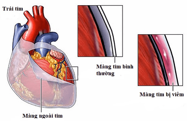  Hình ảnh viêm màng ngoài tim