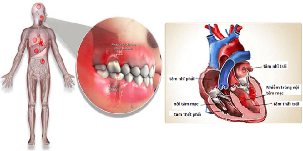 Viêm nội tâm mạc nhiễm trùng