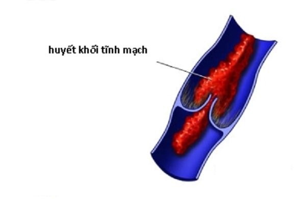 Huyết khối tĩnh mạch