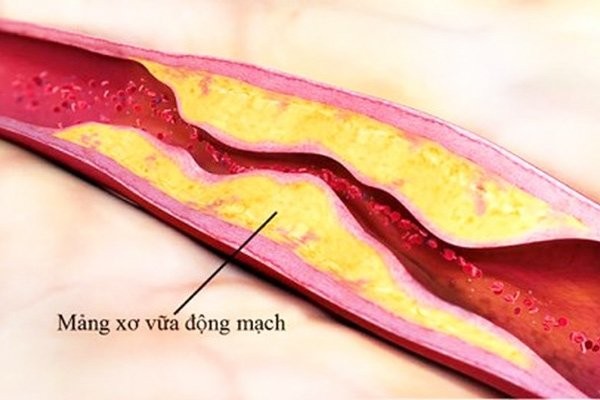 Đây là căn bệnh hết sức nguy hiểm