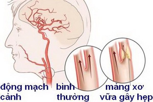 Xơ vữa động mạch cảnh