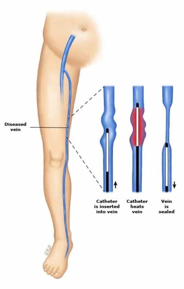 Catheter nhiệt